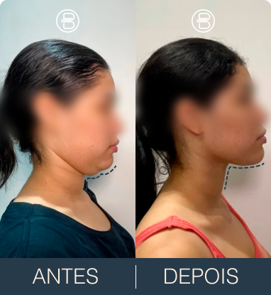 Antes e depois 2