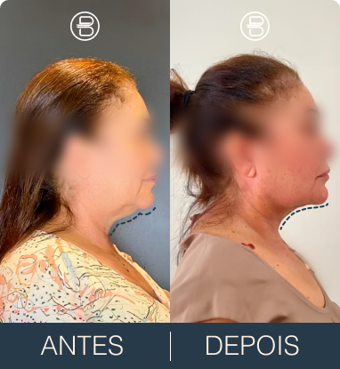 Antes e depois 3